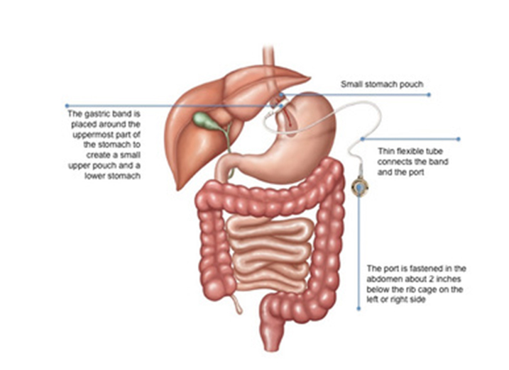 Adjustable Gastric Banding