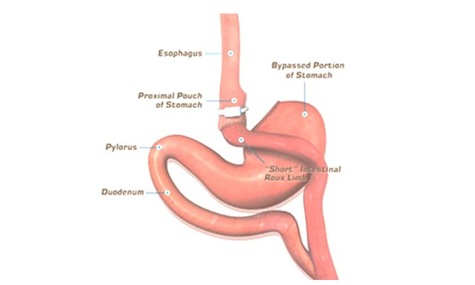 Banded bypass (novel)