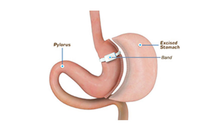 Banded sleeve (novel)