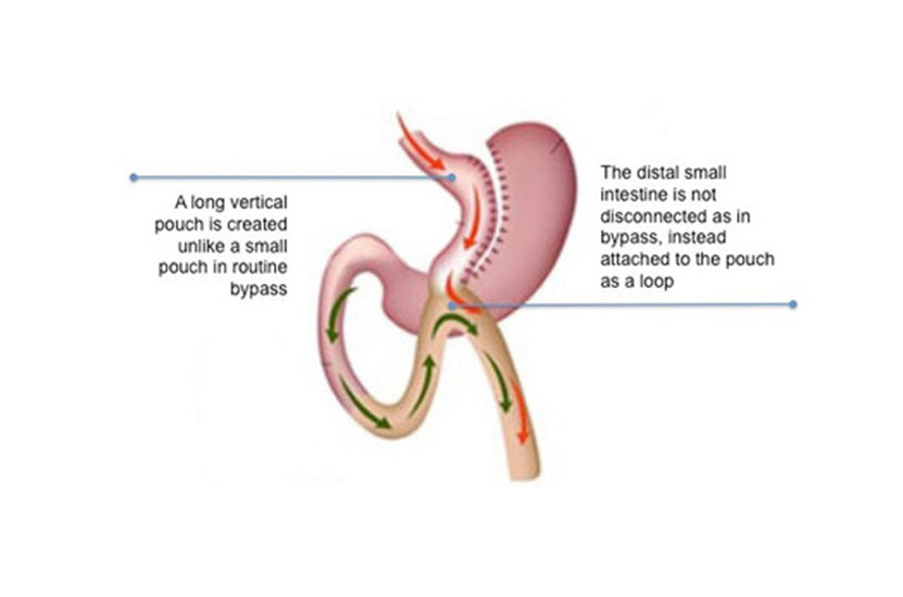 Mini Gastric Bypass