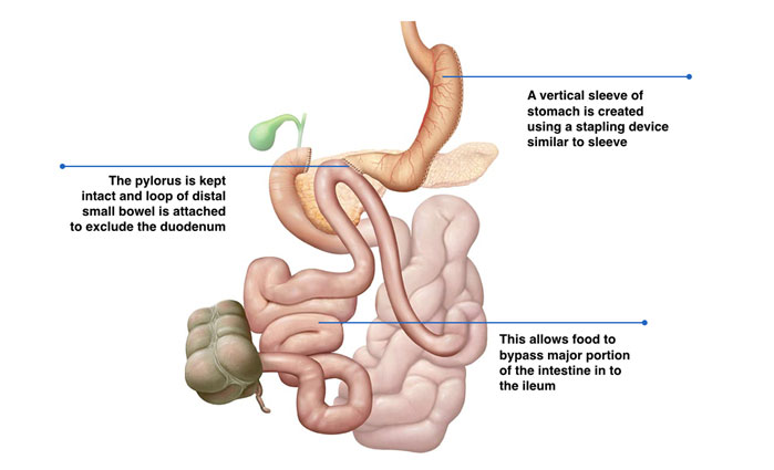 Single Anastomosis Duodeno-Ileal Surgery �SADI  (Novel)