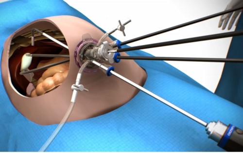 Single Incision Laparoscopic Surgery